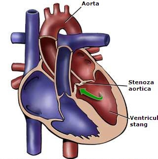 imagini stenoza aortica